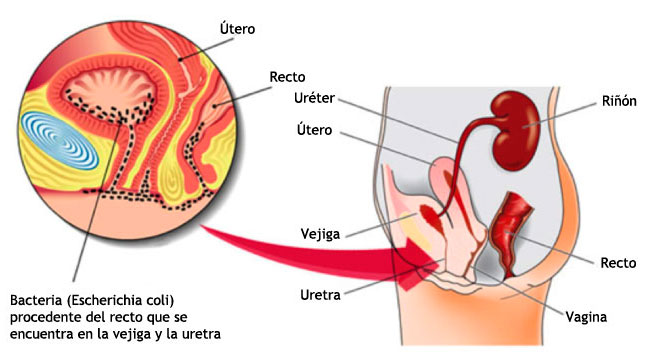 Empleado Fuera de Anécdota ▷ CISTITIS | DUDAS más frecuentes 【 FAQ infecciones urinarias (ITU)】